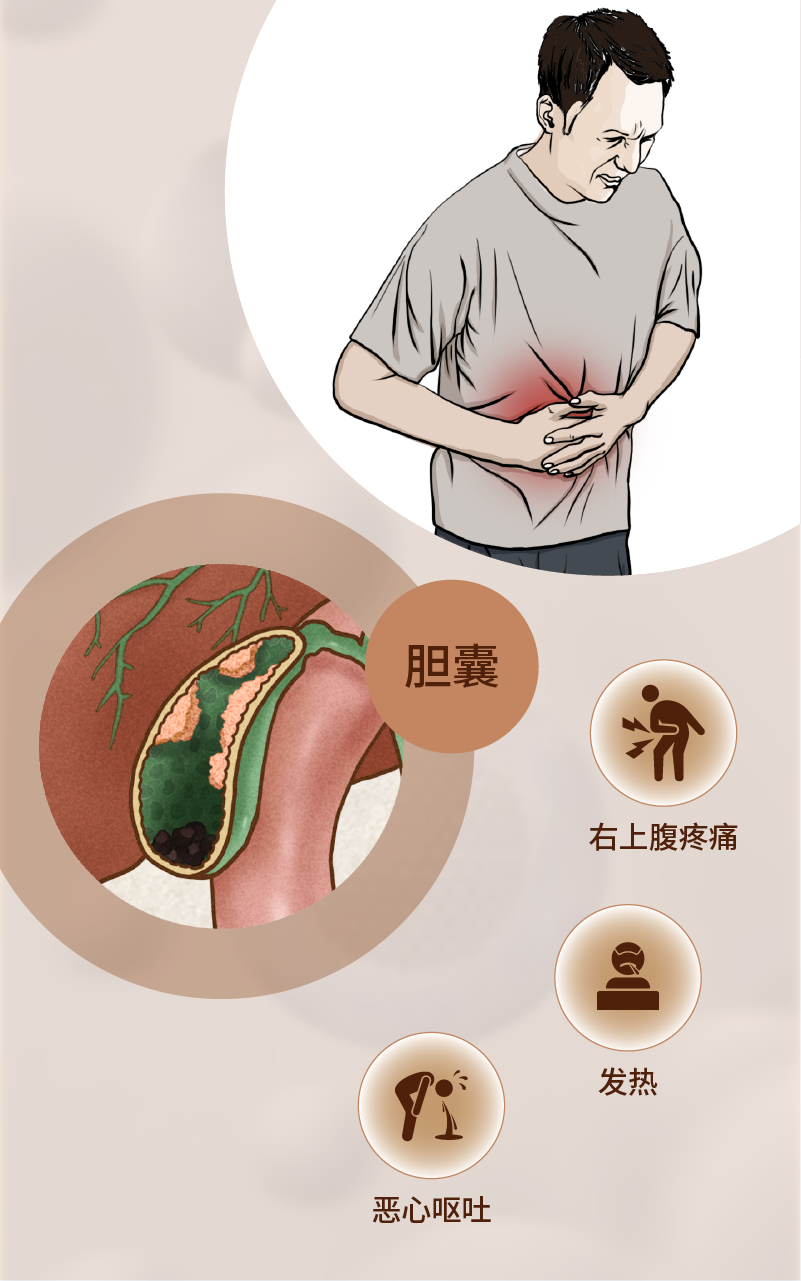 科普|急性胆囊炎怎么治,如何防?