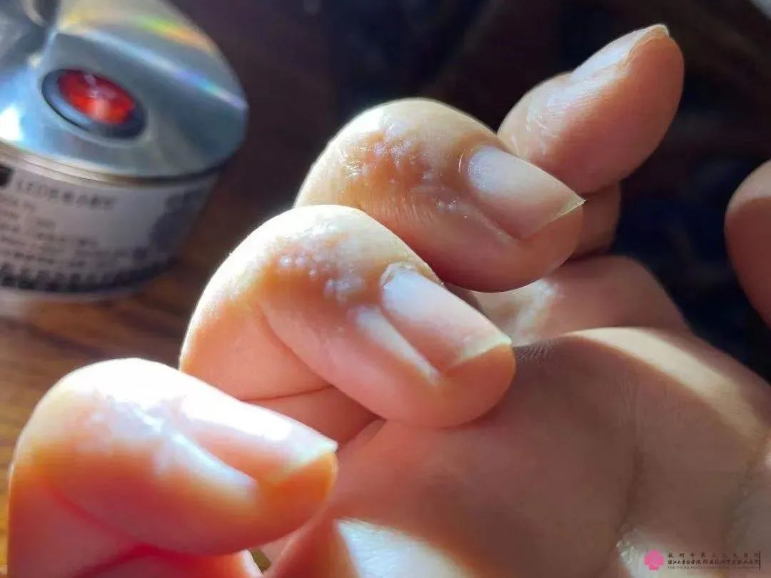 人手指上长出了一些透明的"小水疱",这种水疱其实是一种湿疹叫汗疱疹