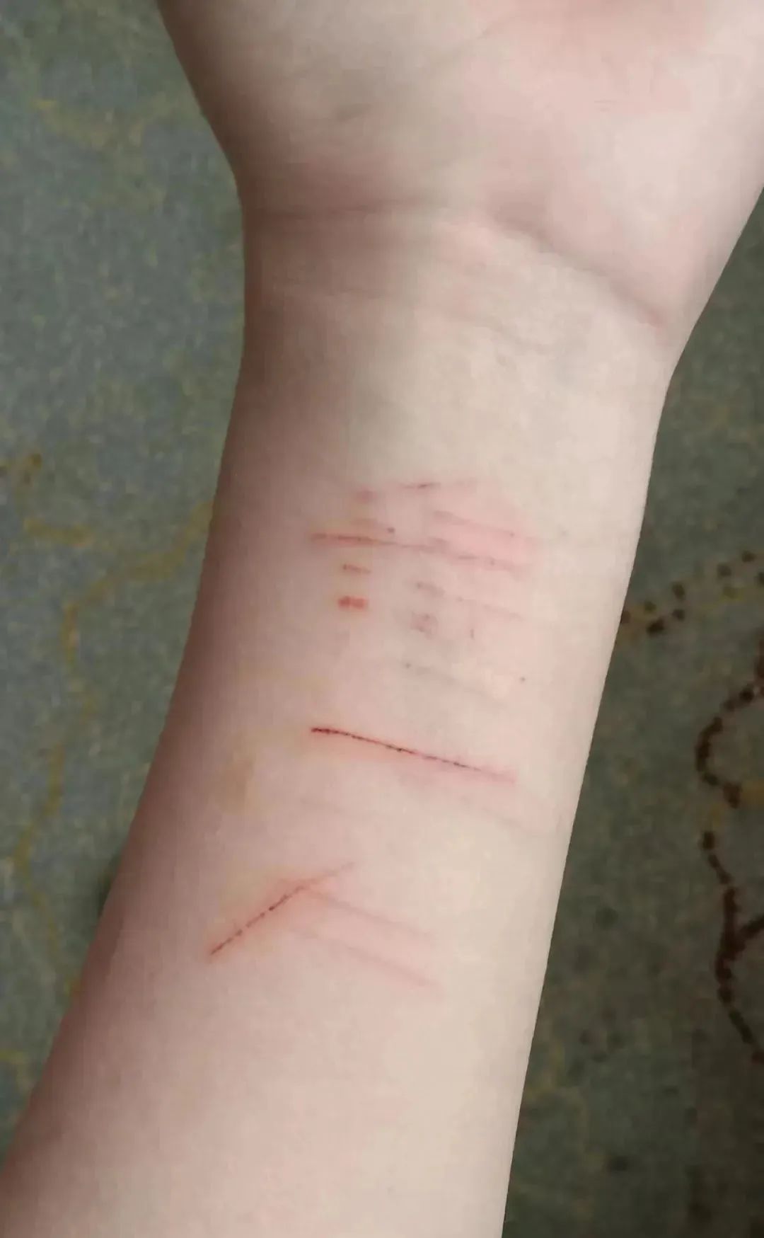 案发后小慧遭受了严重的心理创伤,多次自残.受访者供图