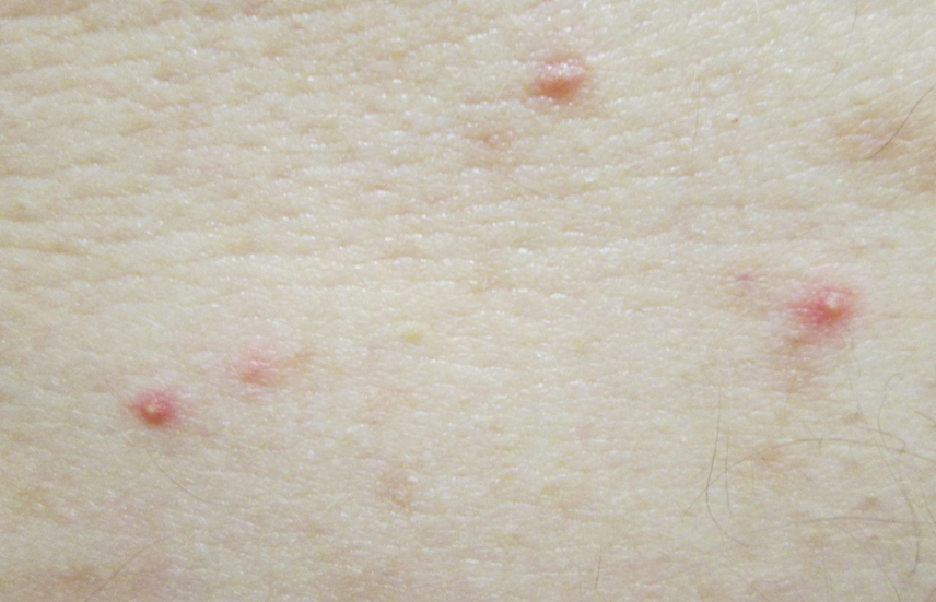 细菌性毛囊炎,顾名思义就是细菌感染引起来的毛囊炎.