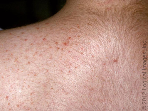 看又看不到,搓也够不着,后背上的痘,到底该怎么祛?