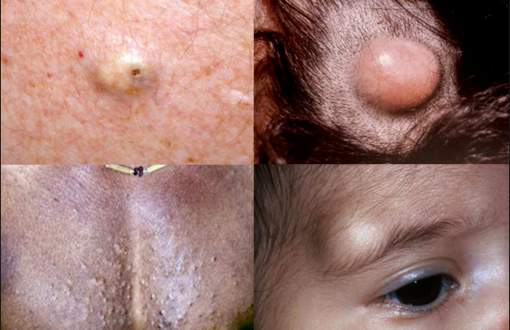 皮肤上长了这种小黑洞,千万别把它当痘痘挤!