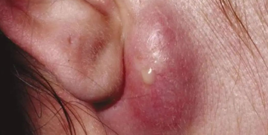 皮肤上长了这种小黑洞,千万别把它当痘痘挤!