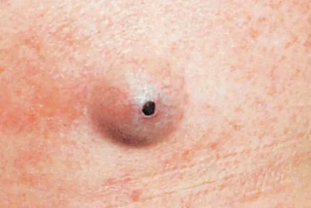 皮肤上长了这种小黑洞,千万别把它当痘痘挤!