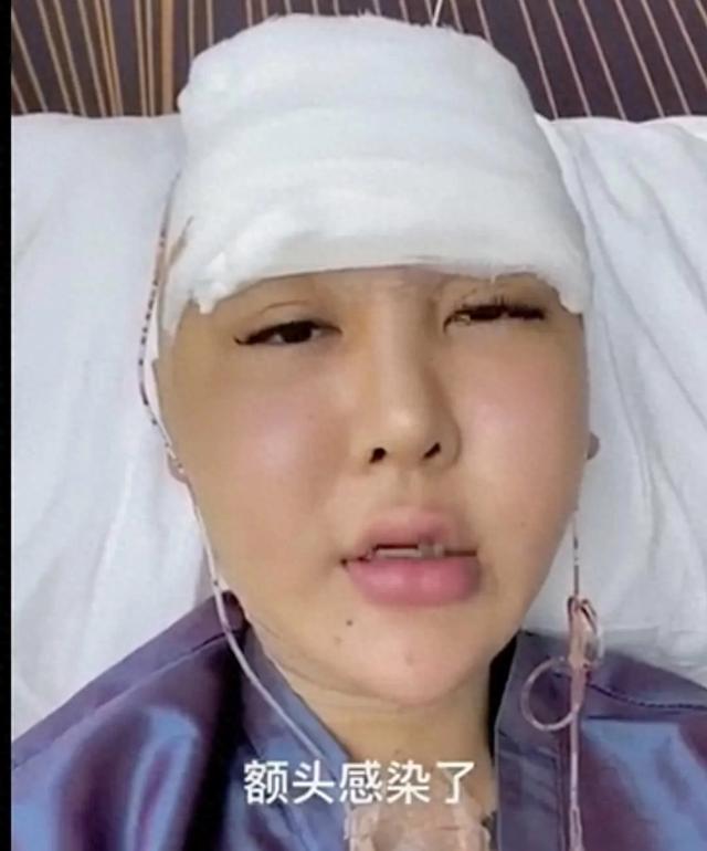 后来屁股里面开始化脓,去医院检查医生说需要立刻取出,因为玻尿酸刺激