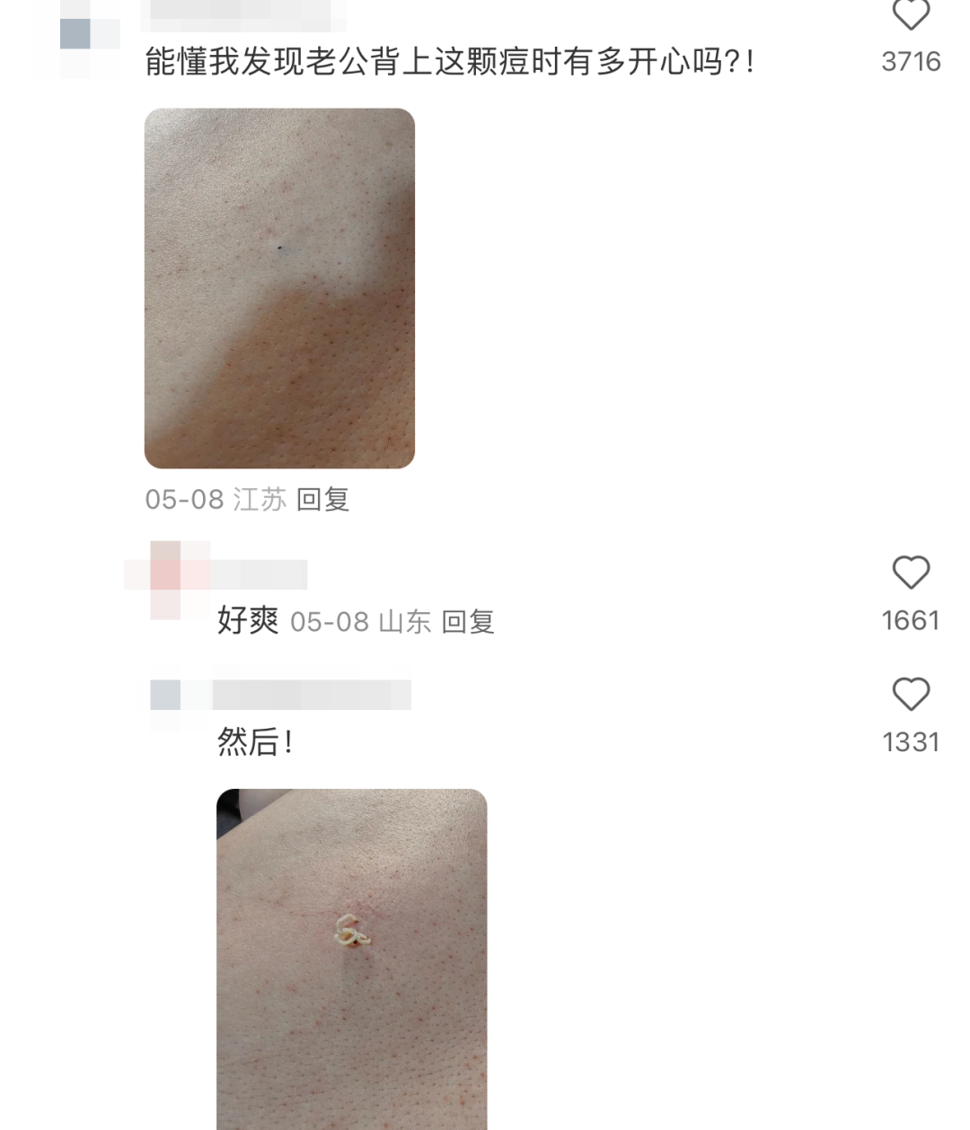 皮肤上长了这种小黑洞,千万别把它当痘痘挤!