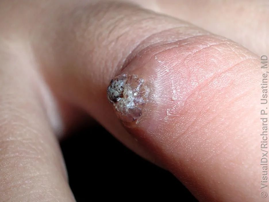 脖子上长这种小肉粒,可能感染了hpv!不要掉以轻心!