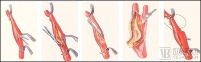 波科支架怎么样11.6亿美元收购，波科想用创新术式独吞市场？_https://www.jmylbn.com_新闻资讯_第3张