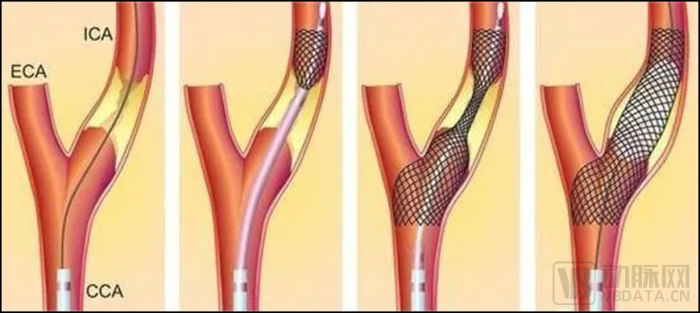 波科支架怎么样11.6亿美元收购，波科想用创新术式独吞市场？_https://www.jmylbn.com_新闻资讯_第4张