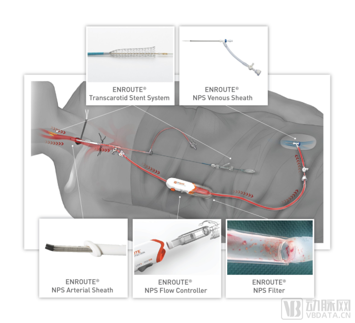 波科支架怎么样11.6亿美元收购，波科想用创新术式独吞市场？_https://www.jmylbn.com_新闻资讯_第6张