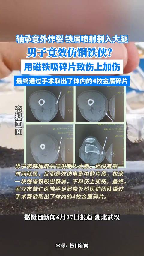 男子效仿钢铁侠磁铁吸腿中铁屑伤上加伤_新浪新闻