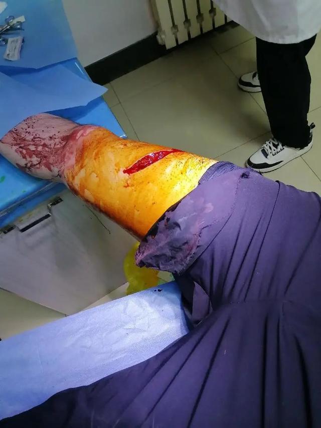 民警8层楼外救下轻生男子,腿部负伤流血浸透警服