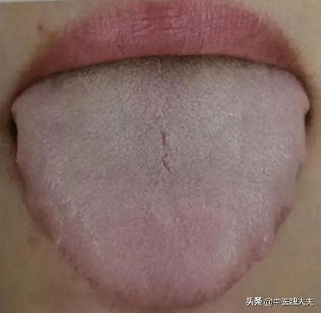 1分钟看懂舌象!自辨“心气虚、脾气虚、肾气虚、肝气虚”|舌根|凹陷|益气|塌方|炒扁豆_新浪新闻