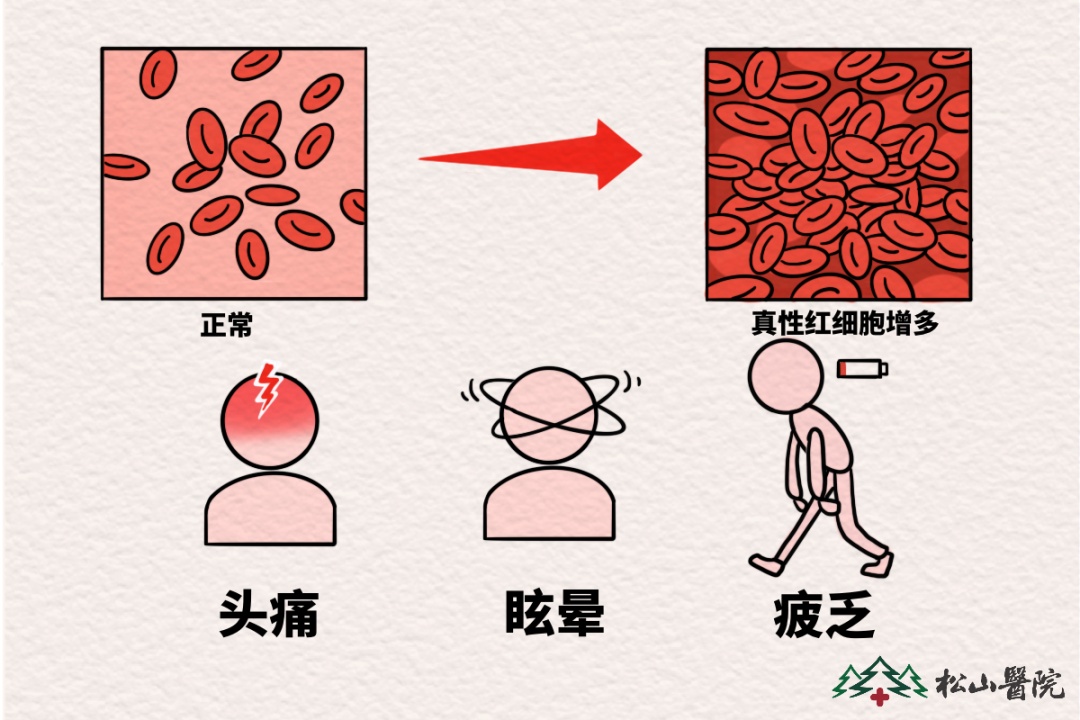 面色红润就是气色好?松山医院:警惕这种罕见血液病|红细胞增多症|血液内科|血红蛋白|红细胞|孙婆婆_新浪新闻