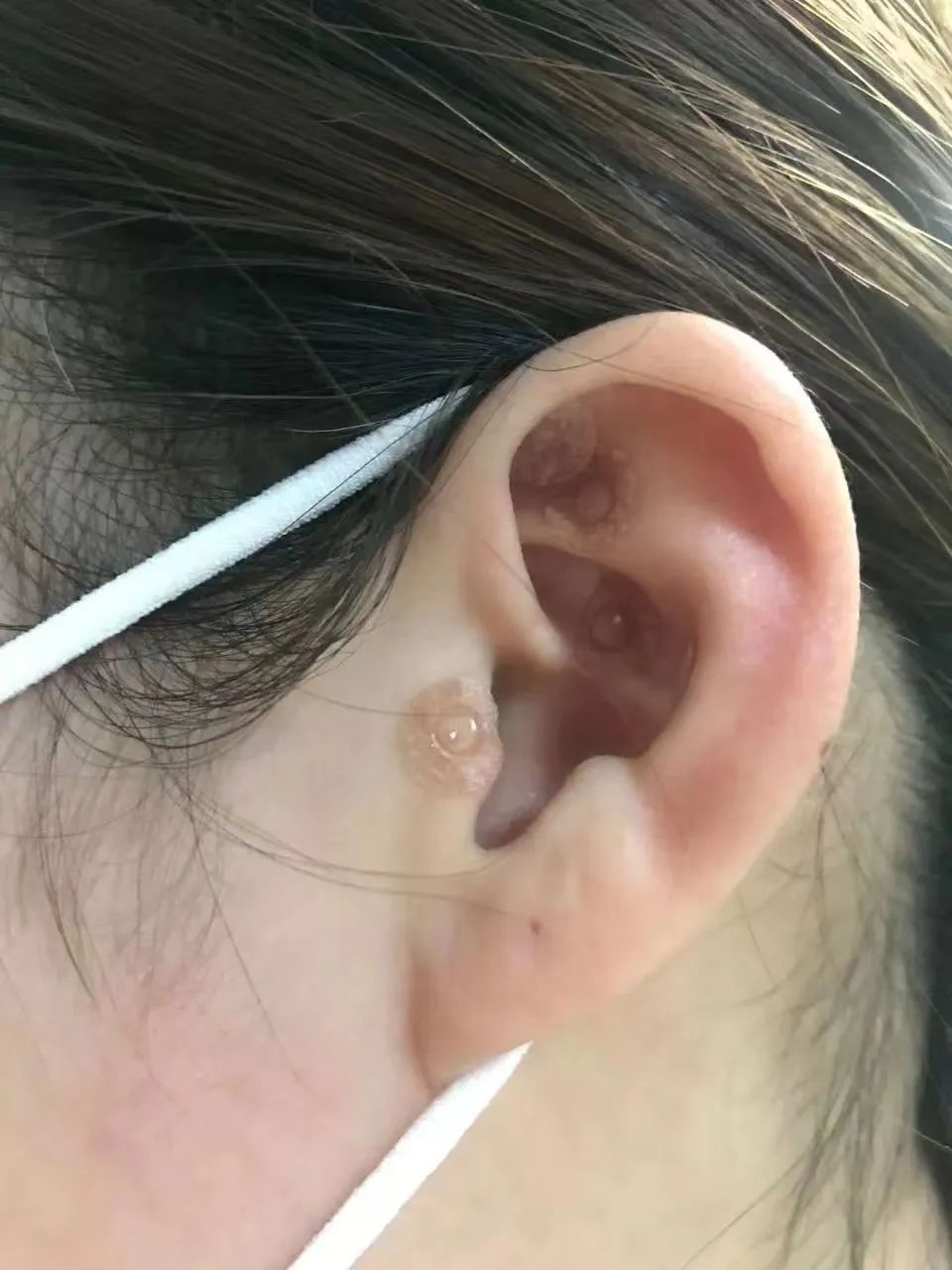 【健康科普】小揿针大用处,穴位埋针更长效