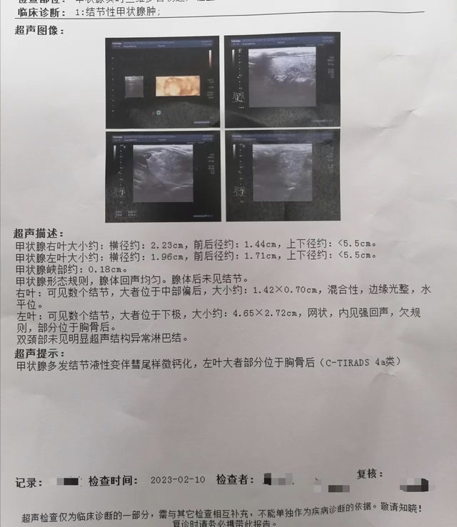 甲状腺全切术5个月后左侧腺叶充满结节:患者质疑漏