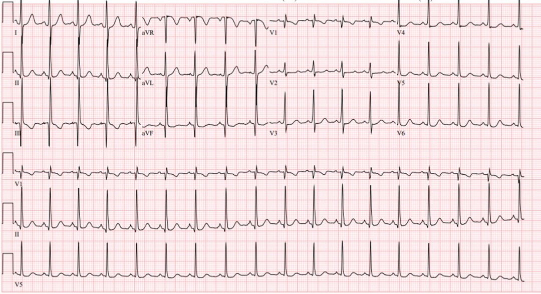 图1 入院心电图:窦性心律,v3-v6导联st段压低0.05mv