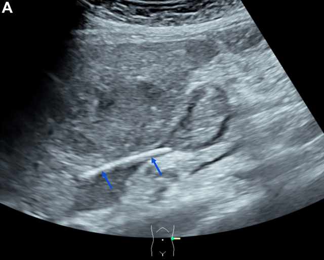 温州一女子突然患上胆囊炎,医生竟从肝脏里掏出了