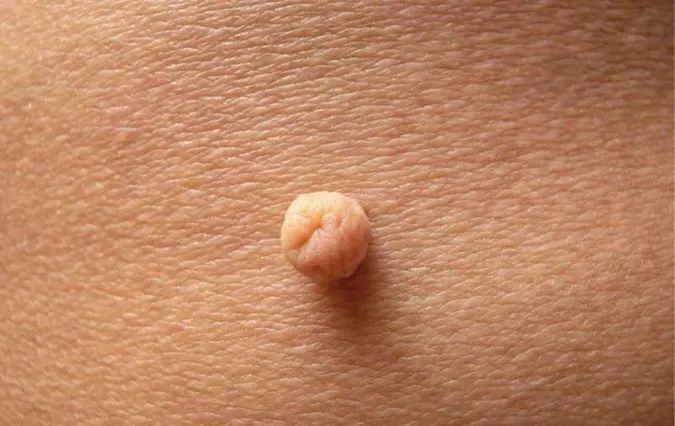 脖子和身上的"小肉粒"是什么?能用手抠掉吗?