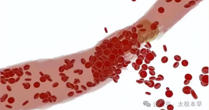血府逐瘀汤,横扫身上一切瘀血,治疗14种病症|头痛_新浪新闻