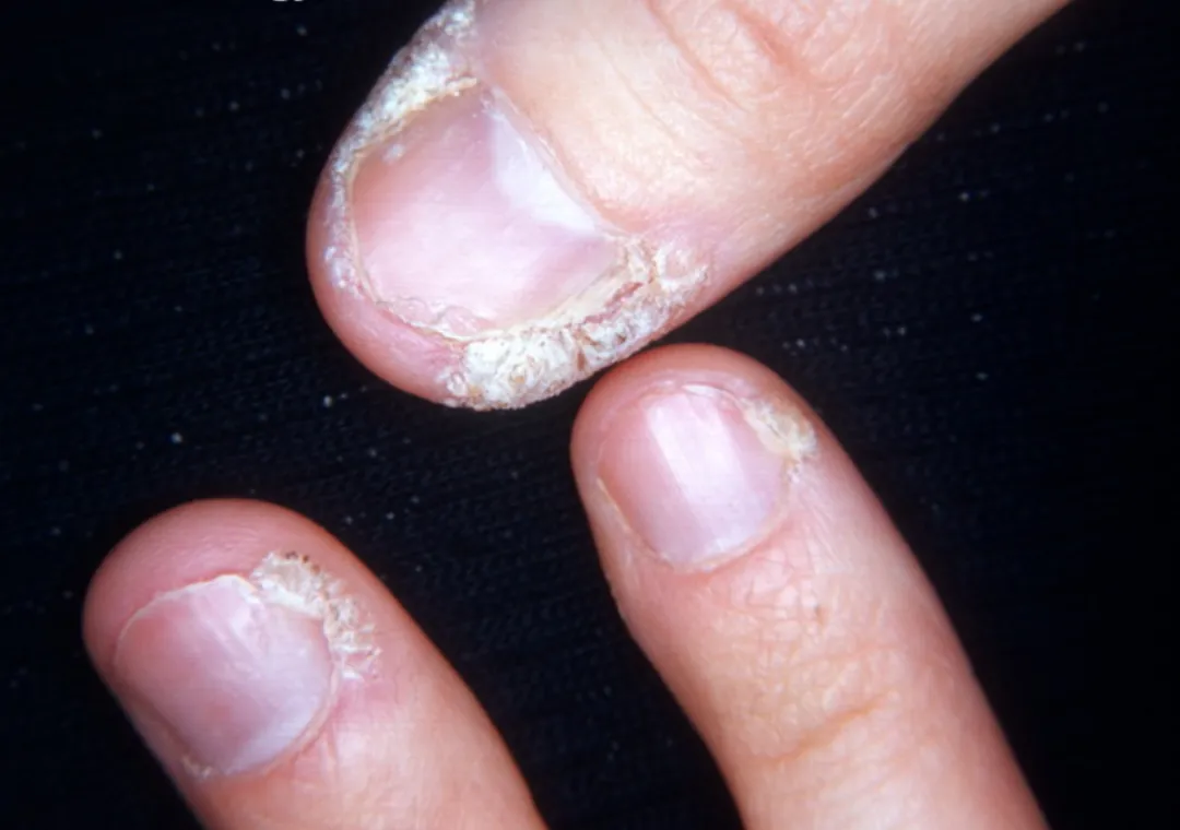 hpv 感染后,多数情况下,人体的免疫系统能够清除病毒.但是,有些时候