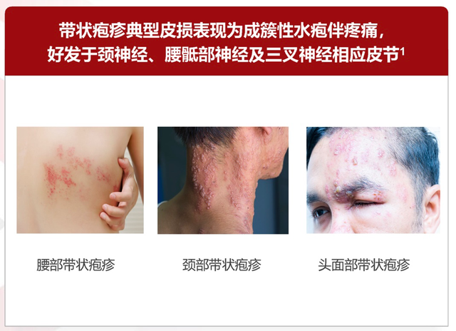 节或颅神经节内的水痘-带状疱疹病毒(vzv)经再激活引起的感染性皮肤病