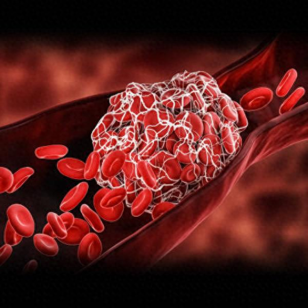 世界血栓日|超声波携手微气泡,科技助力溶解血栓