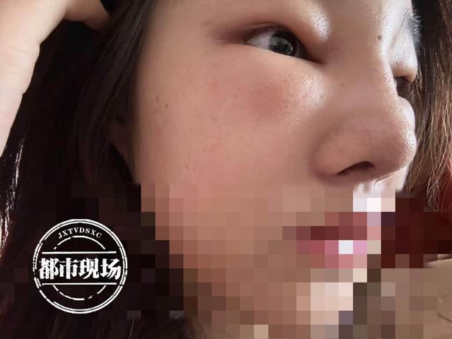 花15000元在简一医美隆鼻脸肿了一片 她说自己“白挨了一刀”(图8)