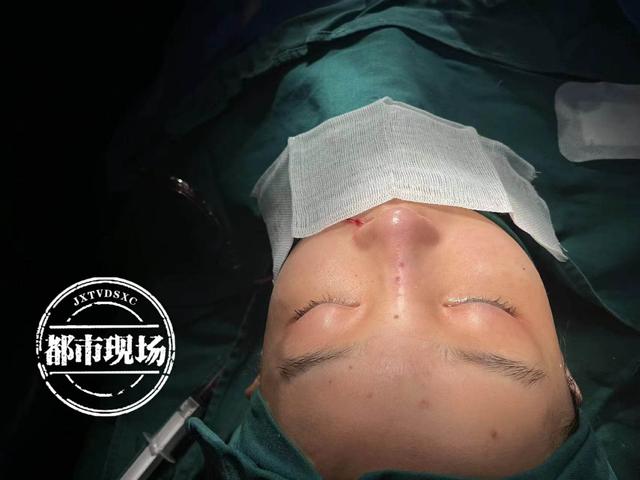 花15000元在简一医美隆鼻脸肿了一片 她说自己“白挨了一刀”(图10)