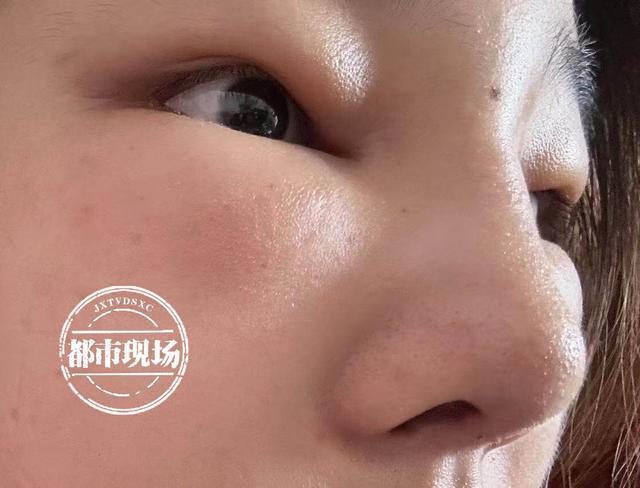 花15000元在简一医美隆鼻脸肿了一片 她说自己“白挨了一刀”(图3)
