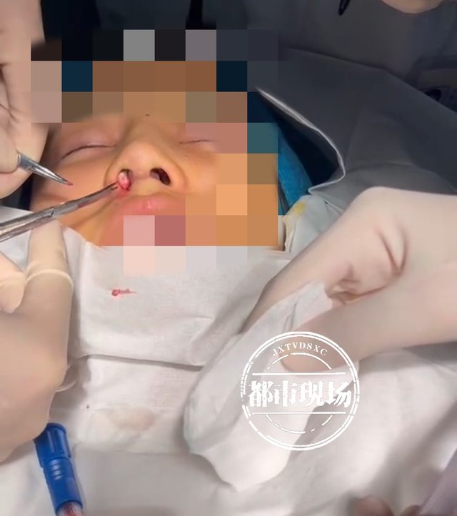花15000元在简一医美隆鼻脸肿了一片 她说自己“白挨了一刀”(图5)