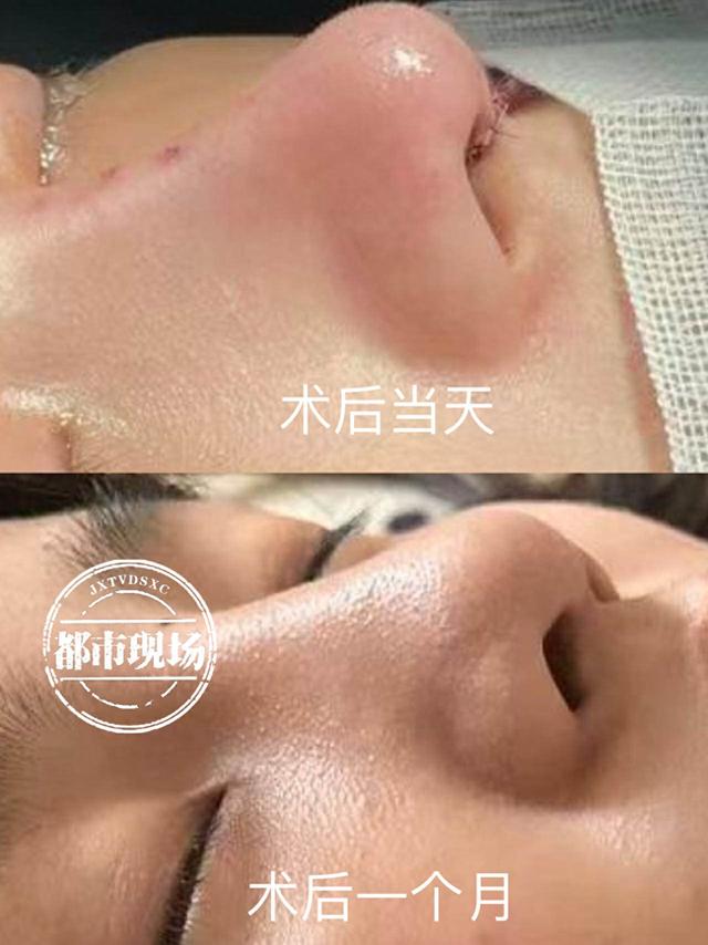 花15000元在简一医美隆鼻脸肿了一片 她说自己“白挨了一刀”(图1)