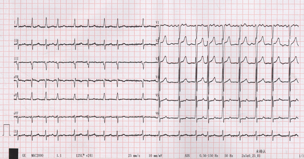 图1：患者的入院心电图