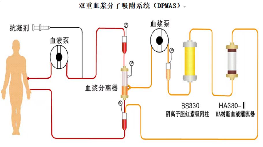 双重血浆分子吸附（DPMAS）治疗图示。