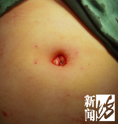 女子肚子里掏出4米长的…很多人都有,但没症状