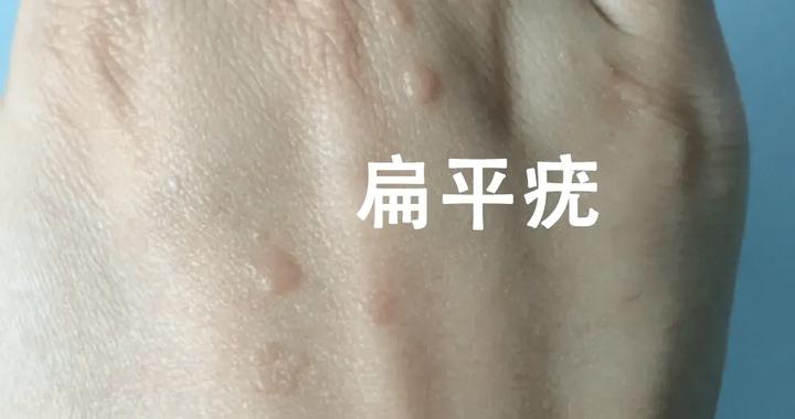 平疣汤治疗扁平疣、寻常疣、丝状疣效果好|归经|功能主治|性味|地骨皮|地肤子_新浪新闻