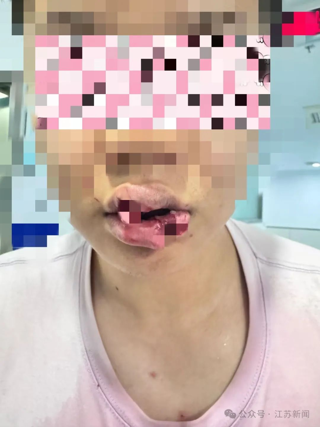 南京一男子与爱宠亲亲被咬下半个嘴唇!