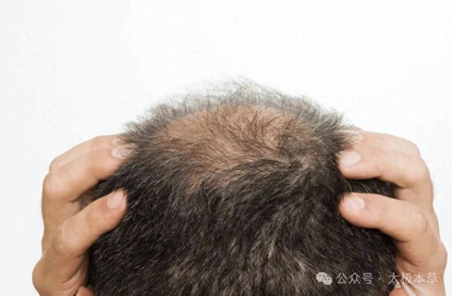 名老中医:屡试屡验生发方|脱发|白术|侧柏叶|黄柏|社会负面_新浪新闻