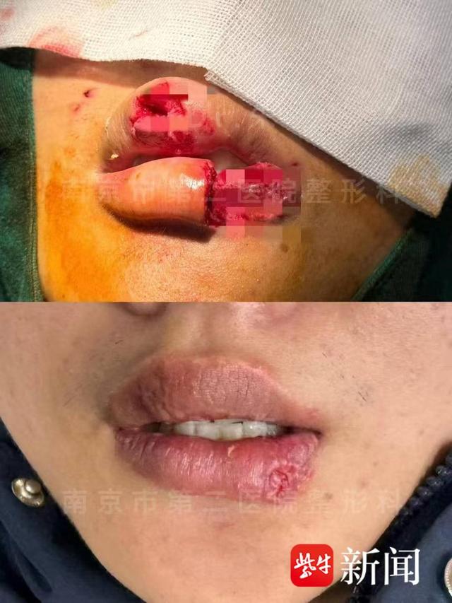 男子与爱宠"亲亲",被咬下半个嘴唇
