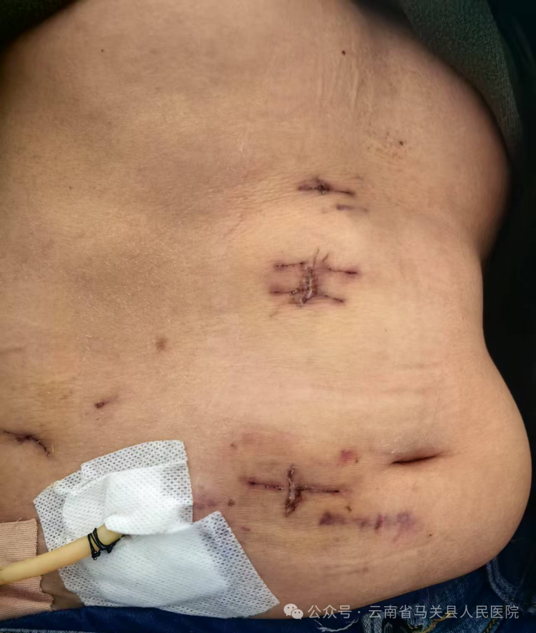 此次手术的成功,是姜永明专家工作站落户马关县人民医院以来的生动