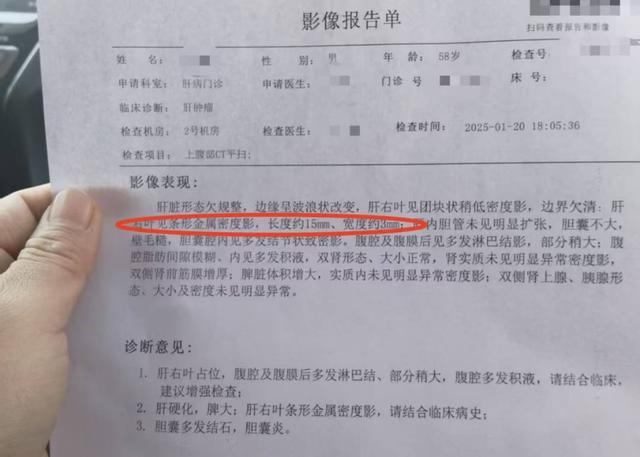 报告显示,患者肝右叶见条形金属密度影,长度约15mm,宽度约3mm.