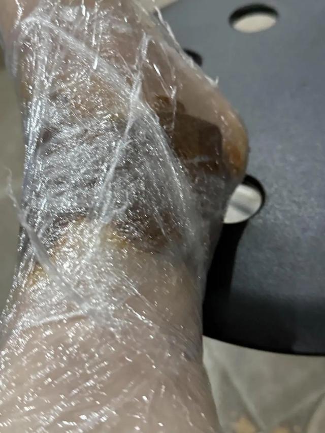 周女士用保鲜薄裹住的外敷方法。受访者供图