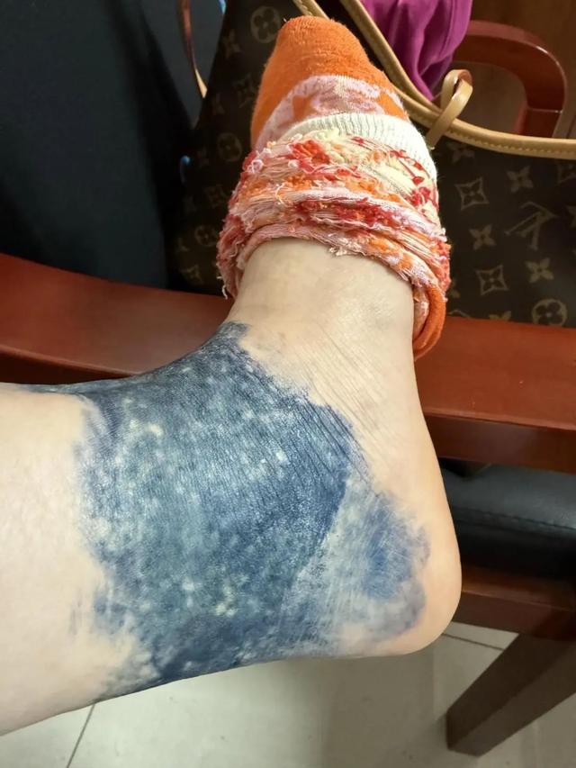 周女士的脚踝处仍有大片染色。受访者供图