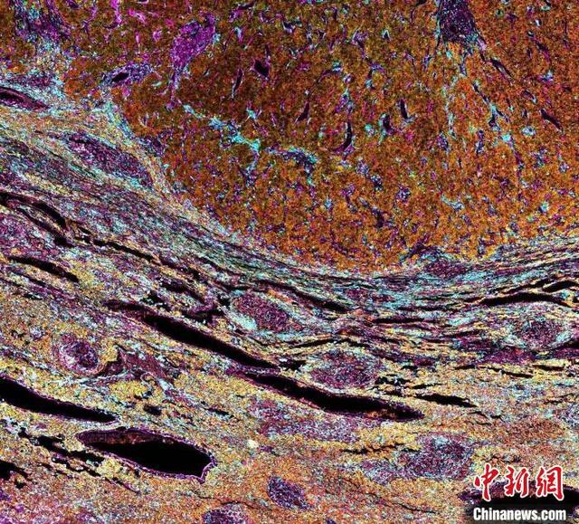 复发组织的代表性多色免疫组化图像。中国科大 供图