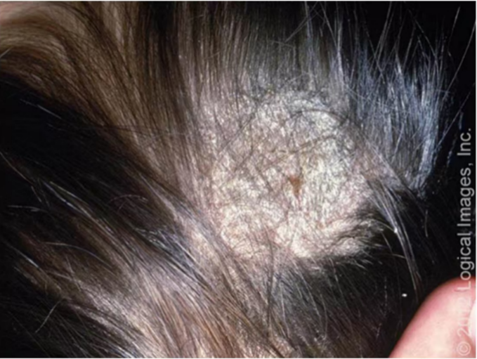 有时还可以看到黄色的脓头,需要考虑头皮细菌性毛囊炎或脓癣