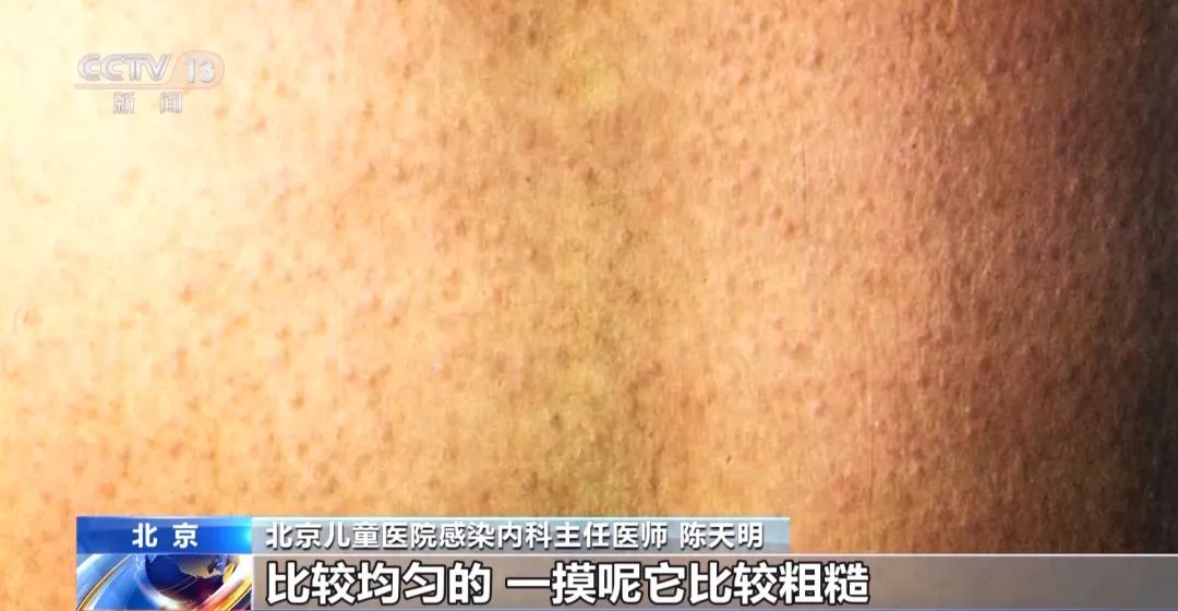 一地确诊1542例！全身皮疹“像鸡皮疙瘩”，尚无疫苗可预防|猩红热_新浪财经_新浪网