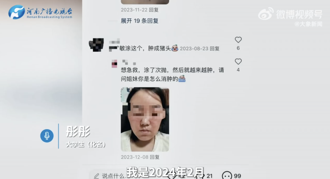 一些消费者通过社交平台也反映过使用可复美产品后面部出现肿胀问题。视频截图