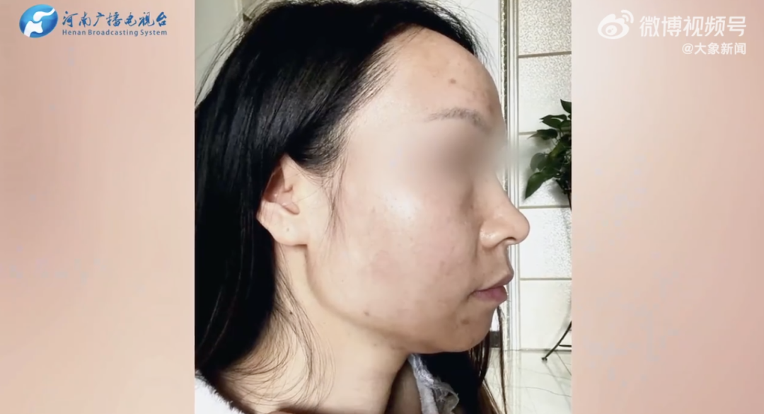 一些消费者通过社交平台也反映过使用可复美产品后面部出现肿胀问题。视频截图