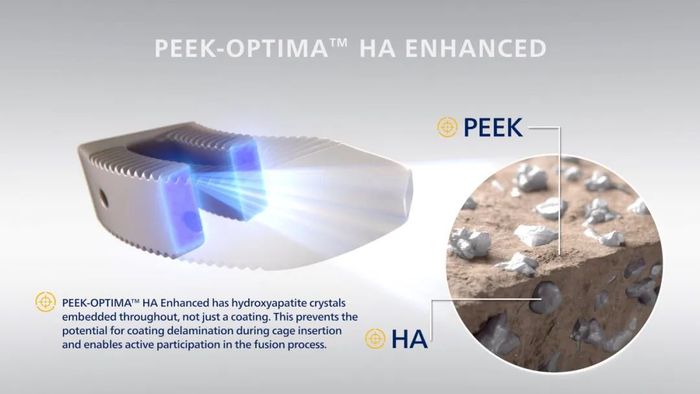 PEEK和羟基磷灰石的复合应用能加速恢复过程，图源企业官网