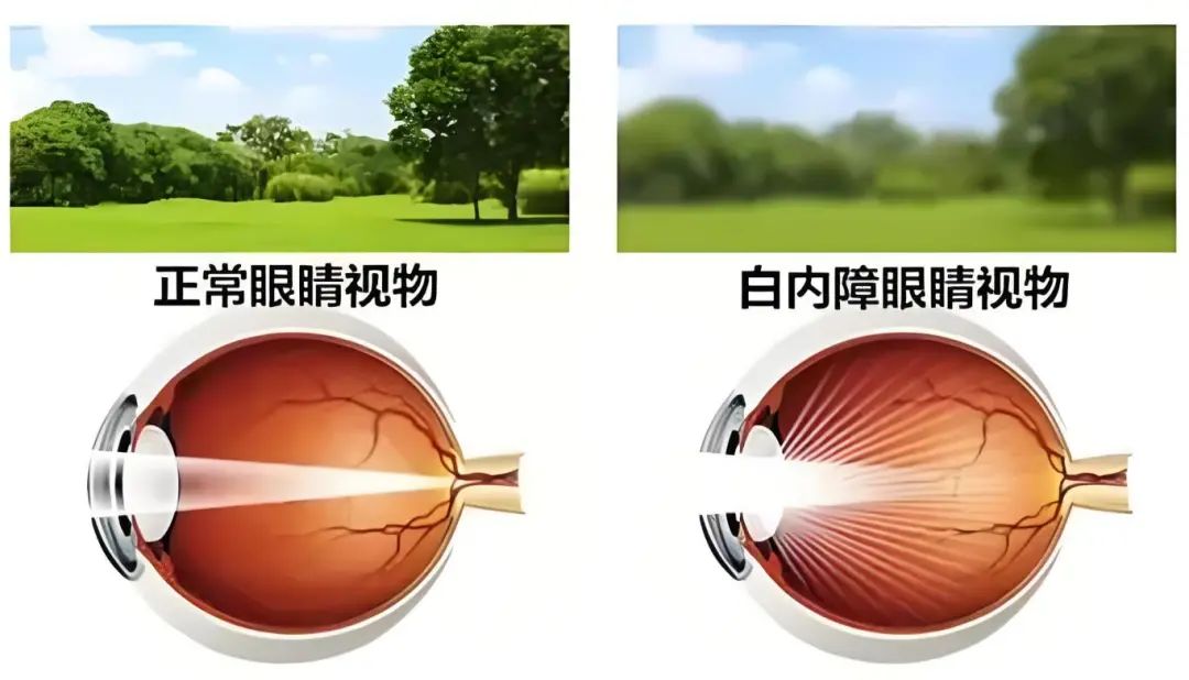 医保惠民生，让复明不再“彷徨”